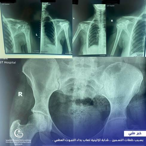 نتيجة استخدام خلطات التسمين .. شابة ثلاثينية تصاب بداء التموت العظمي 